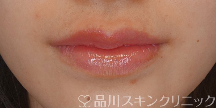 症例NO.72207のAFTER写真