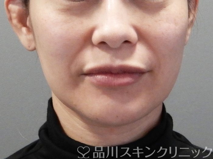 症例NO.72852のBEFORE写真