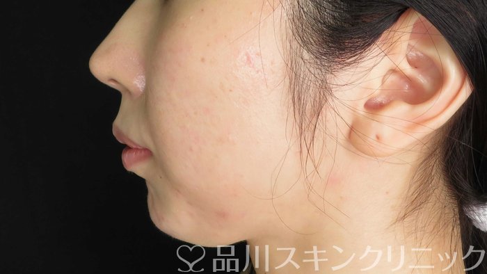 症例NO.71286のAFTER写真