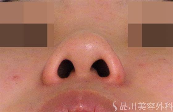 症例NO.39253のBEFORE写真