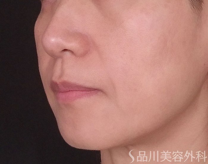 症例NO.72848のBEFORE写真