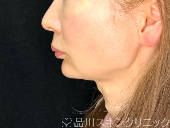 症例NO.72616のAFTER写真