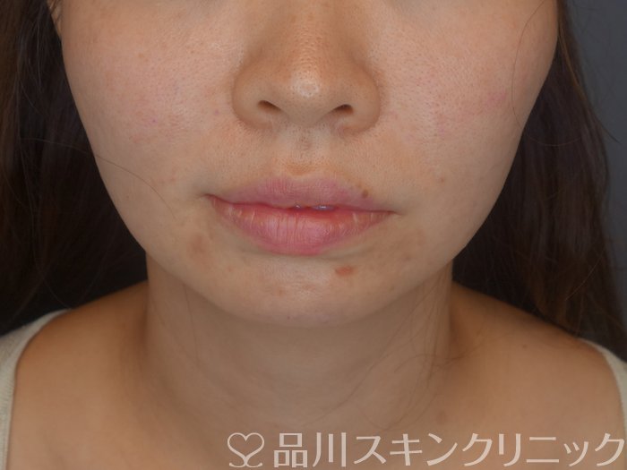 症例NO.71881のAFTER写真