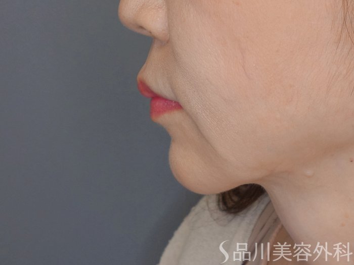 症例NO.71582のBEFORE写真