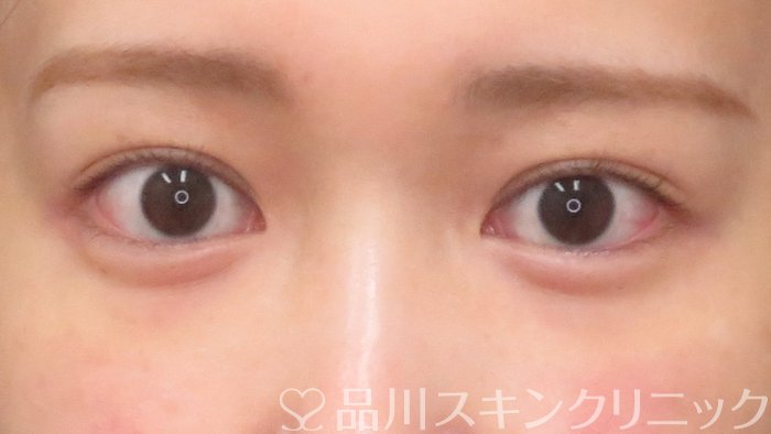 症例NO.69942のAFTER写真
