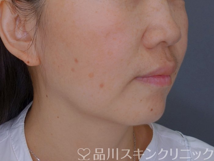 症例NO.74181のBEFORE写真