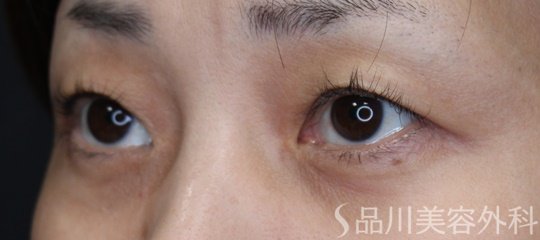 症例NO.69932のBEFORE写真