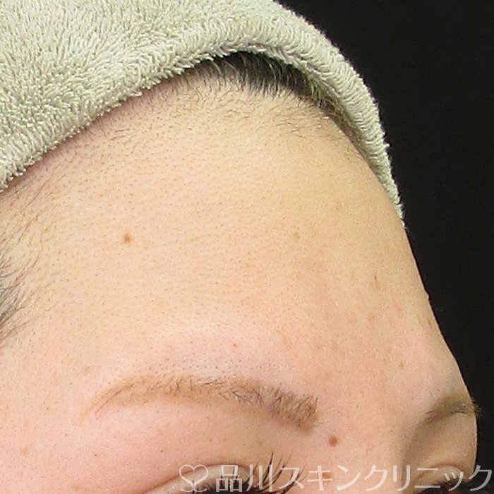 症例NO.70457のBEFORE写真