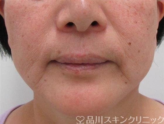 症例NO.34234のBEFORE写真