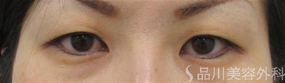 症例NO.24168のBEFORE写真