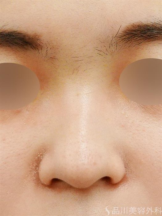 症例NO.49146のAFTER写真