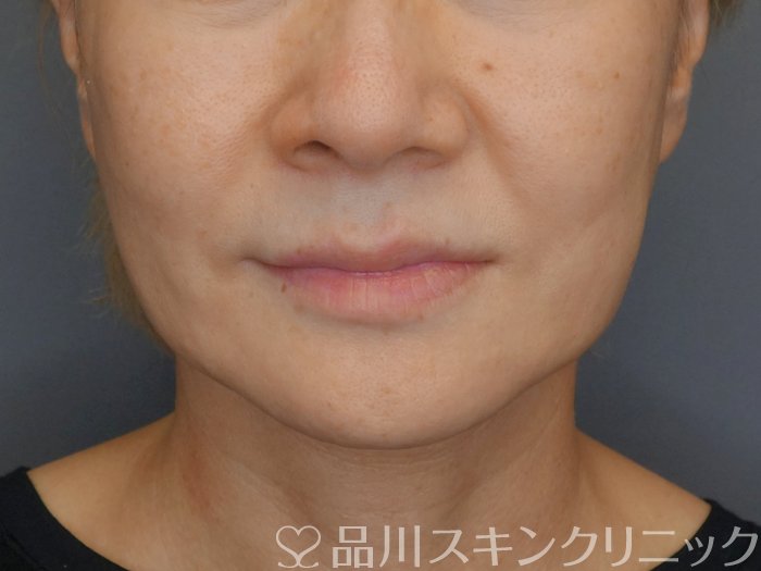 症例NO.71821のBEFORE写真