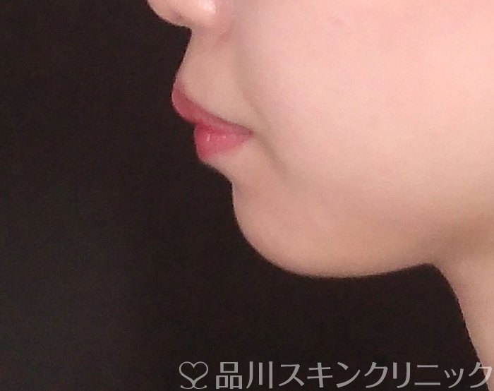 症例NO.69977のBEFORE写真