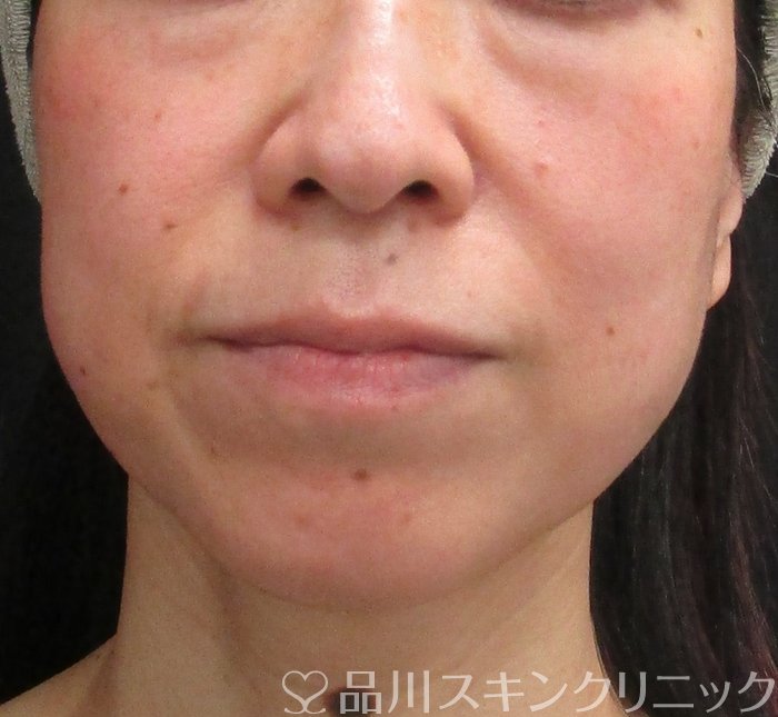 症例NO.72832のBEFORE写真