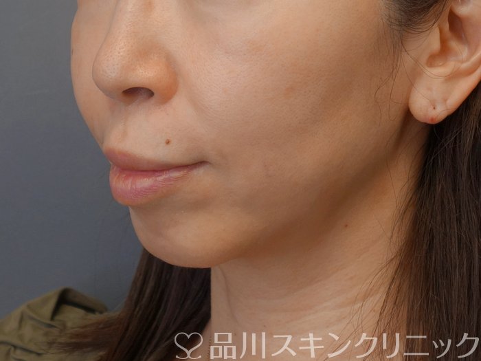症例NO.74615のAFTER写真