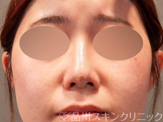 症例NO.71486のAFTER写真