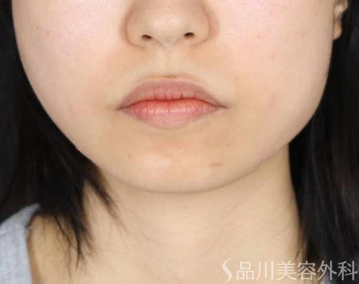 症例NO.72765のBEFORE写真