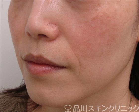 症例NO.41445のBEFORE写真