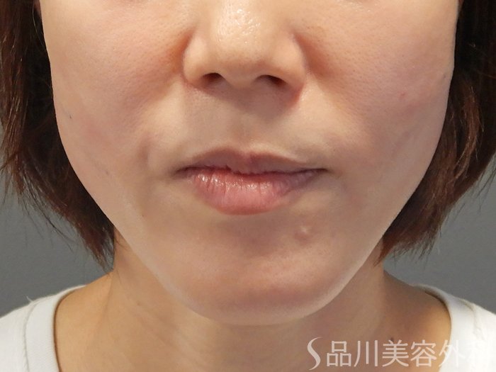 症例NO.71554のAFTER写真