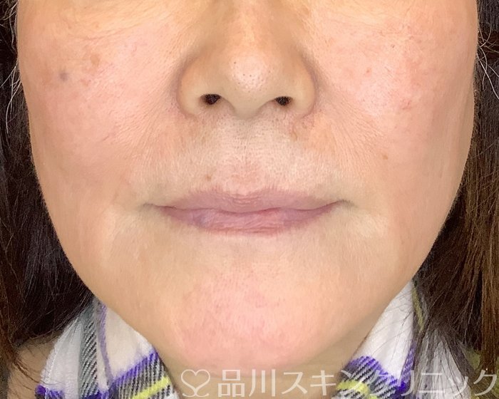 症例NO.69952のBEFORE写真
