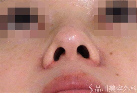 症例NO.38088のAFTER写真