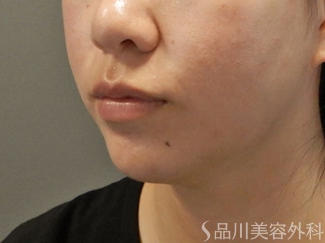 症例NO.71551のBEFORE写真