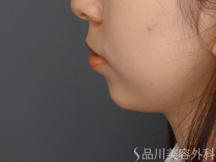 症例NO.65416のAFTER写真