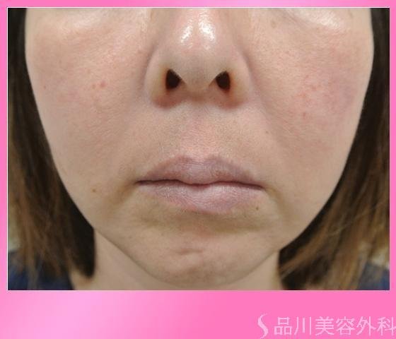 症例NO.11641のBEFORE写真
