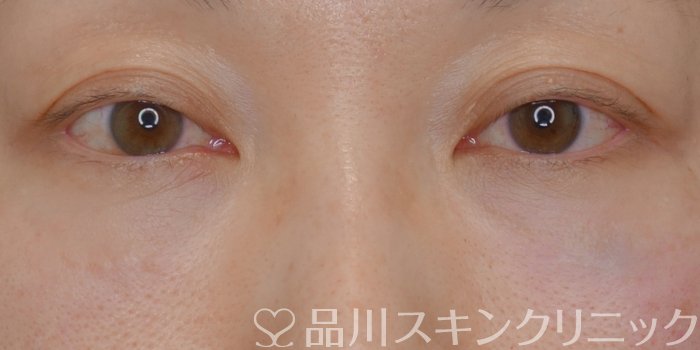 症例NO.72666のAFTER写真