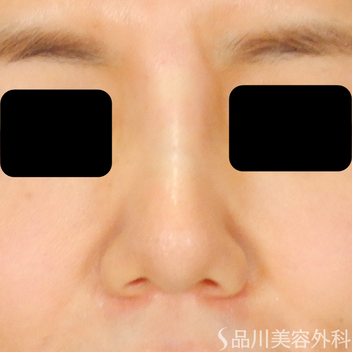 症例NO.67815のAFTER写真