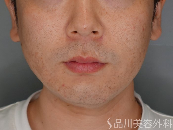 症例NO.73543のAFTER写真