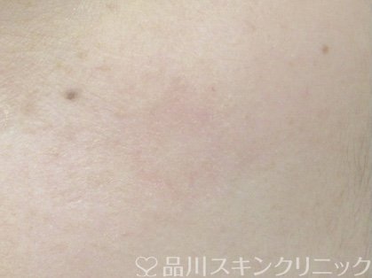 症例NO.64729のAFTER写真