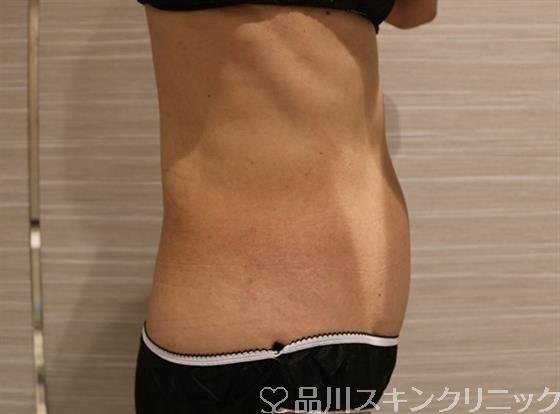 症例NO.41706のAFTER写真
