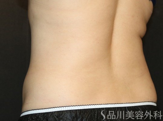 症例NO.75121のAFTER写真
