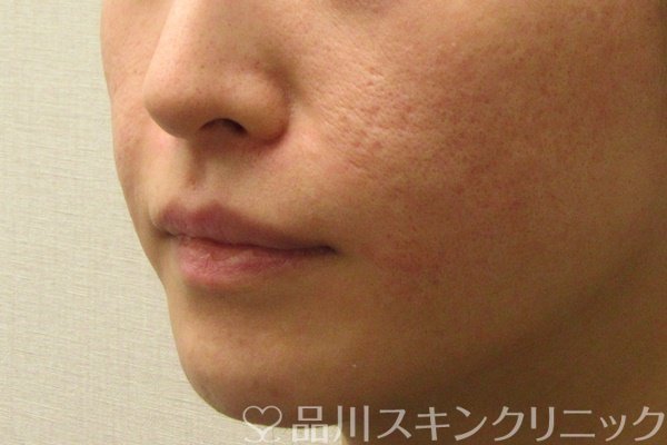 症例NO.72746のAFTER写真