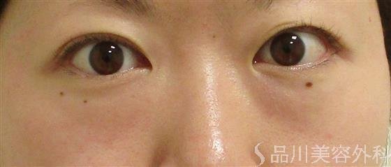 症例NO.57151のBEFORE写真
