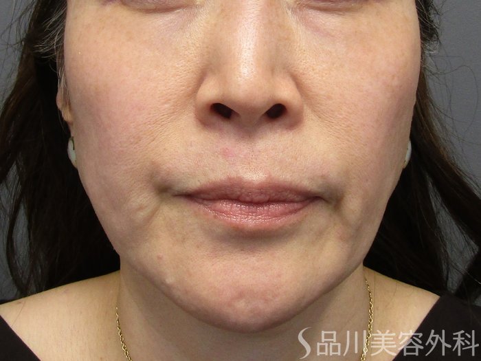 症例NO.75118のBEFORE写真