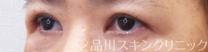 症例NO.70868のAFTER写真