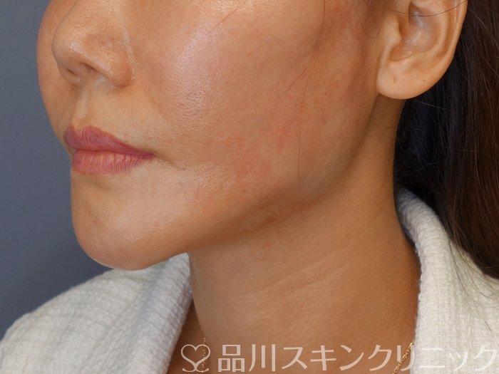 症例NO.71698のAFTER写真