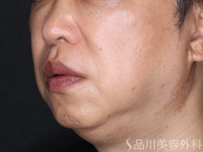 症例NO.75019のAFTER写真