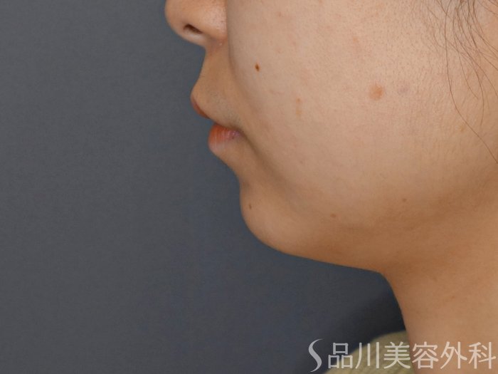 症例NO.70473のBEFORE写真
