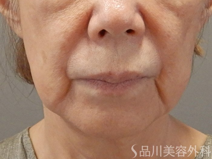 症例NO.71712のBEFORE写真