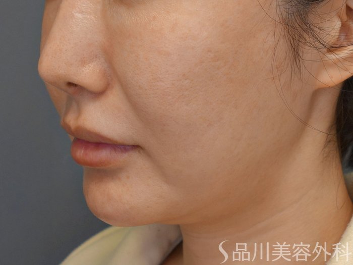 症例NO.73920のBEFORE写真
