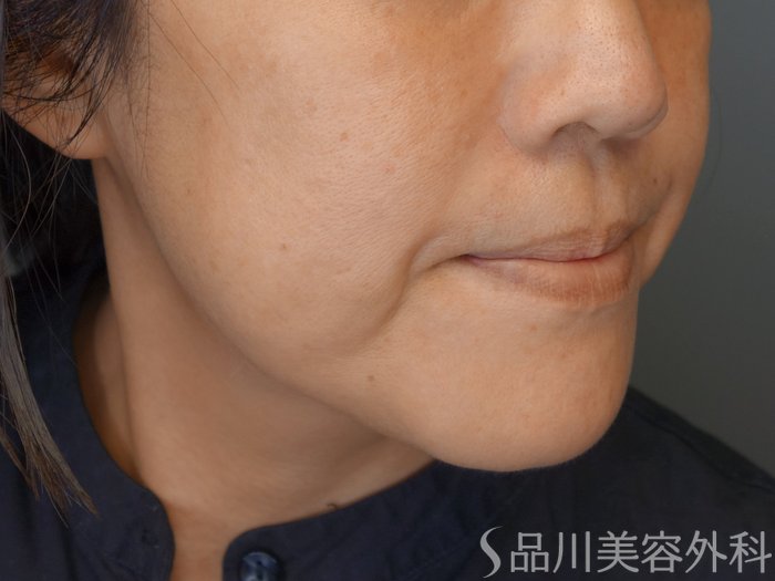症例NO.71705のBEFORE写真