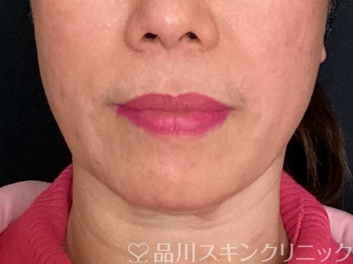 症例NO.65276のBEFORE写真