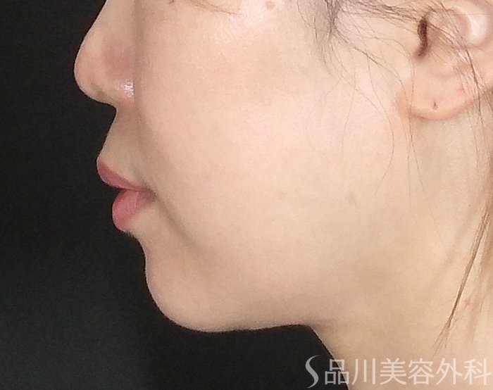 症例NO.64880のBEFORE写真