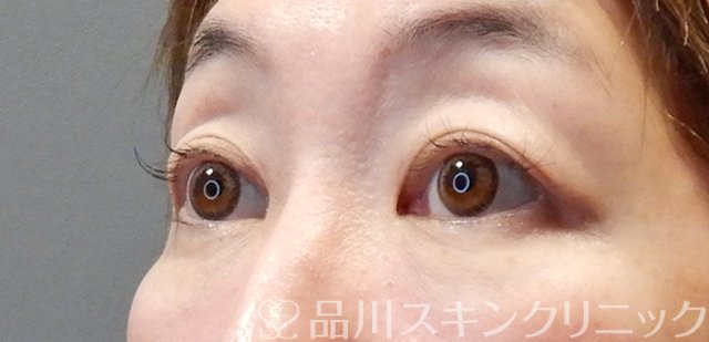症例NO.67658のBEFORE写真