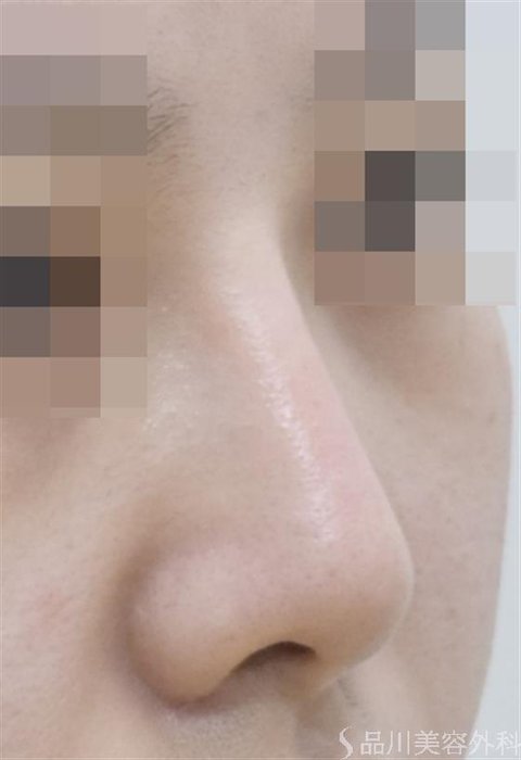 症例NO.46734のAFTER写真