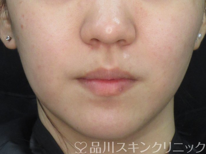 症例NO.73488のAFTER写真