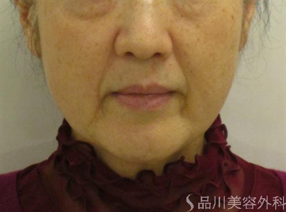 症例NO.58178のBEFORE写真